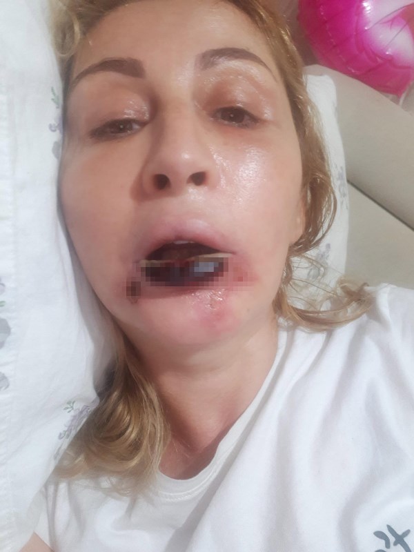 Estetik Faciasında 7 Yıllık Adalet Çığlığı: "Gülüşüm ve Sağlığım Geri Gelmedi"