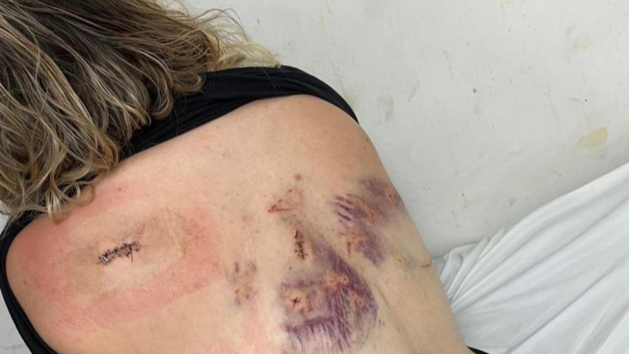 Antalya'da Korkunç Saldırı! Eski Erkek Arkadaşının Bıçağı Sırtında Kırıldı